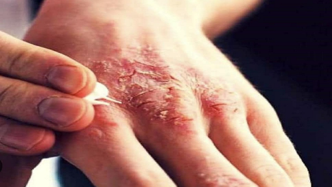 Scabies Disease Threatens the Lives of Juvenile Prisoners in Ofer Prison
